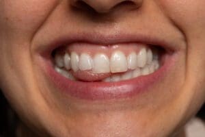 Are you unhappy with your gummy smile? Do you feel self-conscious about the appearance of your teeth because your gums are too prominent or uneven?