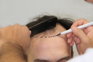 For many men in the UK, hair transplants have become the go-to solution for restoring confidence and tackling hair loss. However, the cost of a hair transplant in the UK can be daunting, often ranging between £5,000 and £15,000 depending on the clinic, technique, and number of grafts.